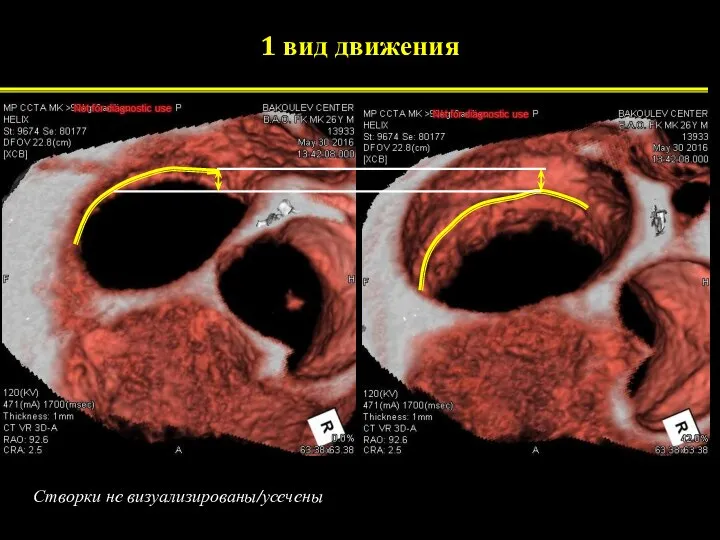 1 вид движения Створки не визуализированы/усечены