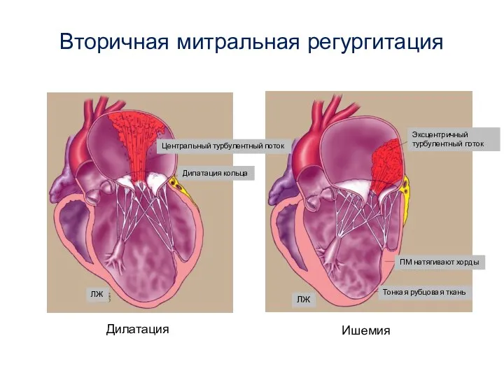 Вторичная митральная регургитация Дилатация Ишемия Центральный турбулентный поток Дилатация кольца Эксцентричный турбулентный