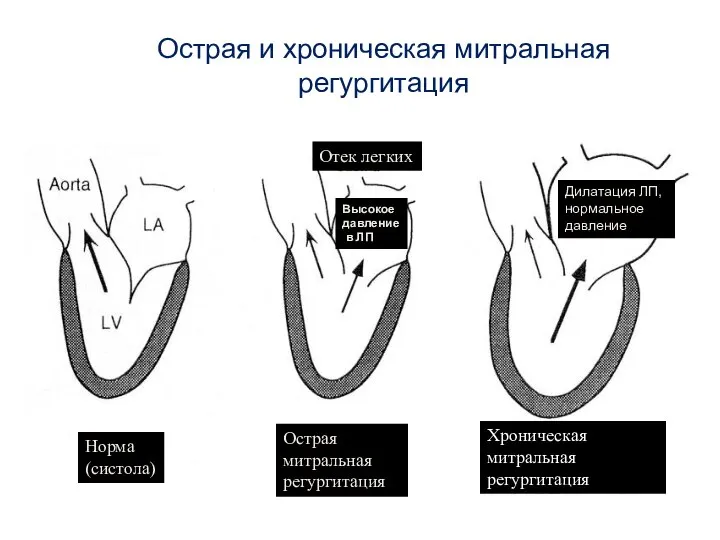 Острая и хроническая митральная регургитация Норма (систола) Острая митральная регургитация Хроническая митральная