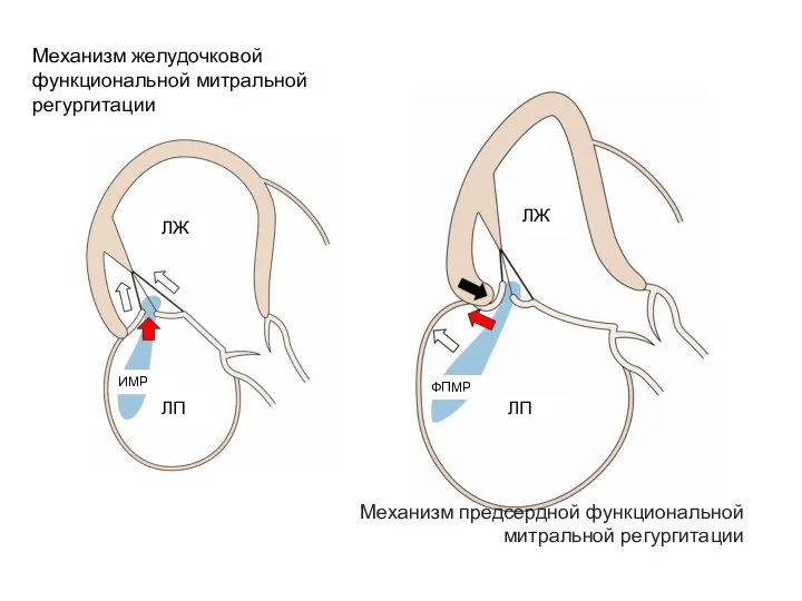 Механизм желудочковой функциональной митральной регургитации ЛЖ ЛП ИМР Механизм предсердной функциональной митральной регургитации