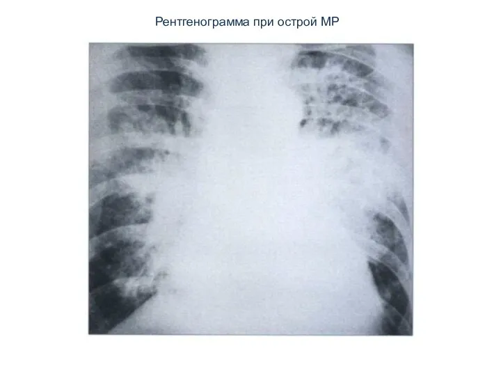 Рентгенограмма при острой МР
