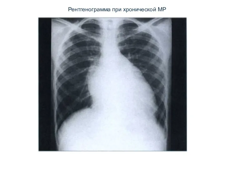 Рентгенограмма при хронической МР