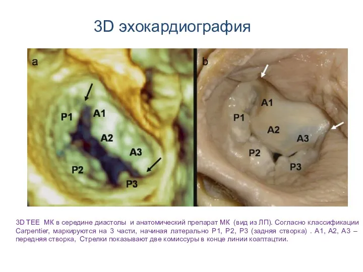 3D эхокардиография 3D TEE МК в середине диастолы и анатомический препарат МК