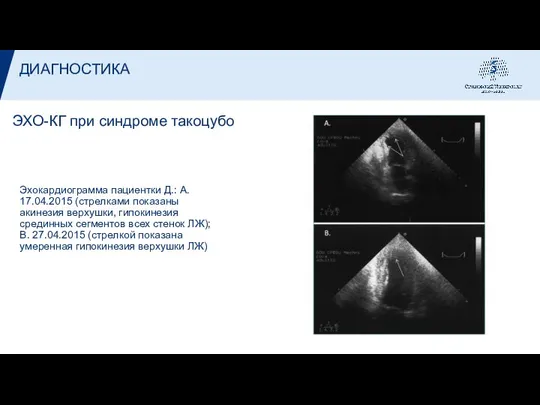 ЭХО-КГ при синдроме такоцубо Эхокардиограмма пациентки Д.: A. 17.04.2015 (стрелками показаны акинезия