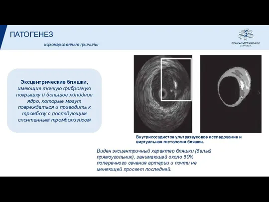ПАТОГЕНЕЗ Эксцентрические бляшки, имеющие тонкую фиброзную покрышку и большое липидное ядро, которые