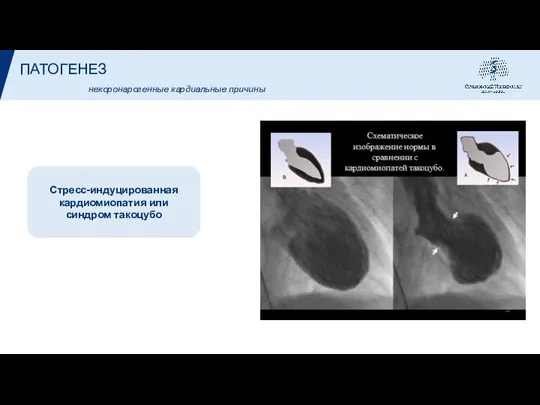 ПАТОГЕНЕЗ Стресс-индуцированная кардиомиопатия или синдром такоцубо некоронарогенные кардиальные причины