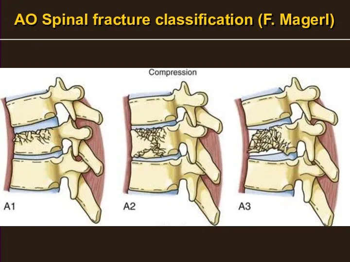 AO Spinal fracture classification (F. Magerl)