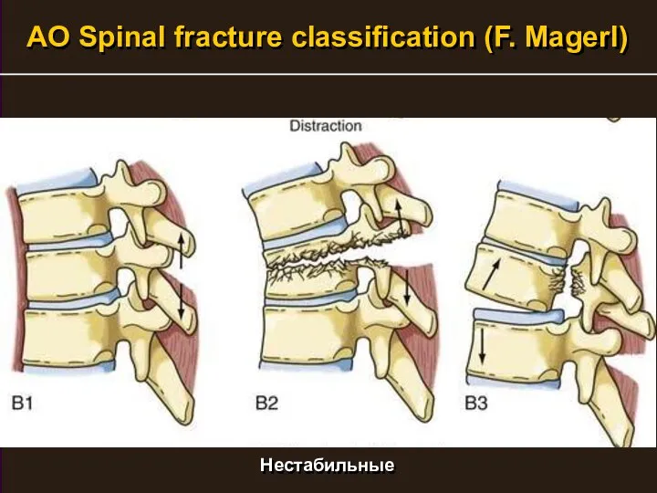 AO Spinal fracture classification (F. Magerl) Нестабильные