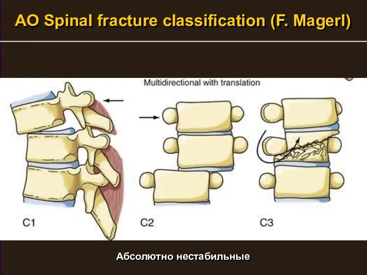 AO Spinal fracture classification (F. Magerl) Абсолютно нестабильные