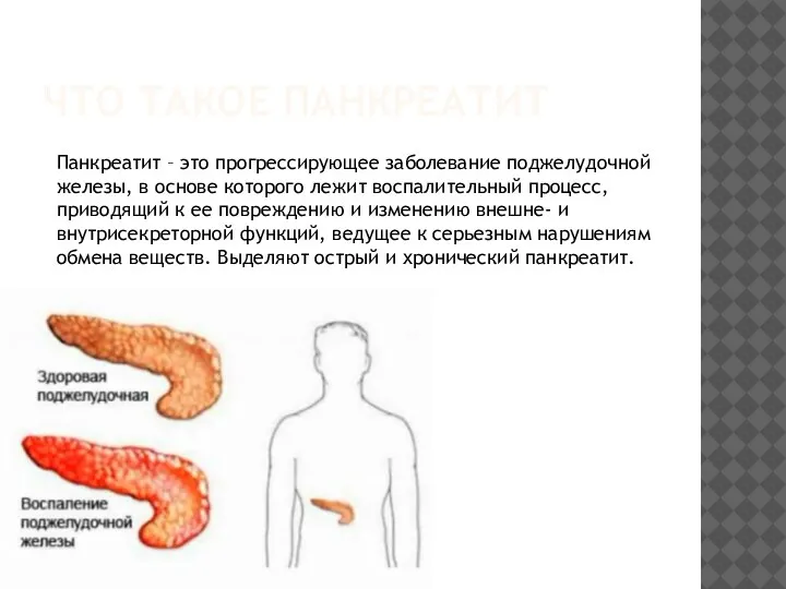 ЧТО ТАКОЕ ПАНКРЕАТИТ Панкреатит – это прогрессирующее заболевание поджелудочной железы, в основе