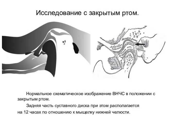 Исследование с закрытым ртом. Нормальное схематическое изображение ВНЧС в положении с закрытым