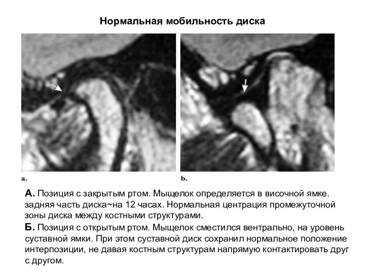 Нормальная мобильность диска А. Позиция с закрытым ртом. Мыщелок определяется в височной