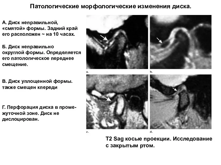 Патологические морфологические изменения диска. Т2 Sag косые проекции. Исследование с закрытым ртом.