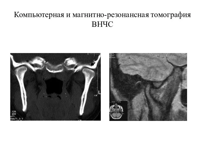 Компьютерная и магнитно-резонансная томография ВНЧС