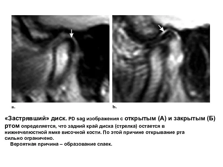 «Застрявший» диск. PD sag изображения с открытым (А) и закрытым (Б) ртом