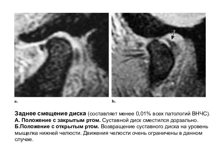 Заднее смещение диска (составляет менее 0,01% всех патологий ВНЧС). А. Положение с
