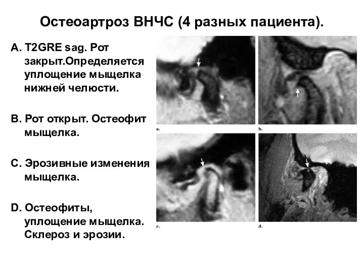 Остеоартроз ВНЧС (4 разных пациента). А. Т2GRE sag. Рот закрыт.Определяется уплощение мыщелка