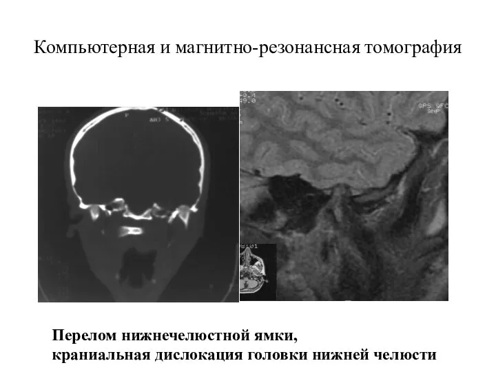 Компьютерная и магнитно-резонансная томография Перелом нижнечелюстной ямки, краниальная дислокация головки нижней челюсти