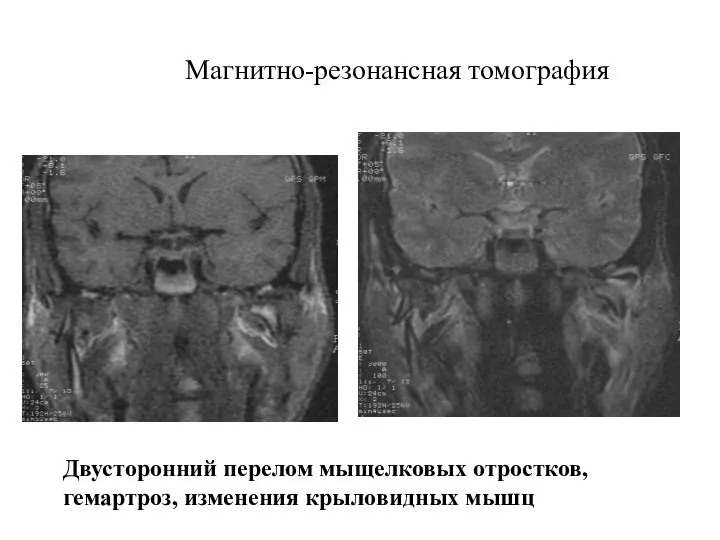Магнитно-резонансная томография Двусторонний перелом мыщелковых отростков, гемартроз, изменения крыловидных мышц