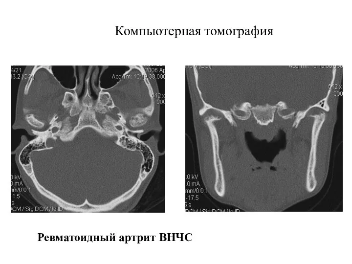 Компьютерная томография Ревматоидный артрит ВНЧС