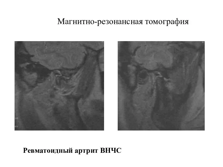 Магнитно-резонансная томография Ревматоидный артрит ВНЧС
