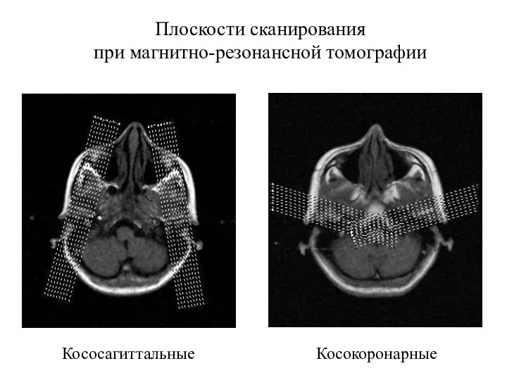 Плоскости сканирования при магнитно-резонансной томографии Кососагиттальные Косокоронарные