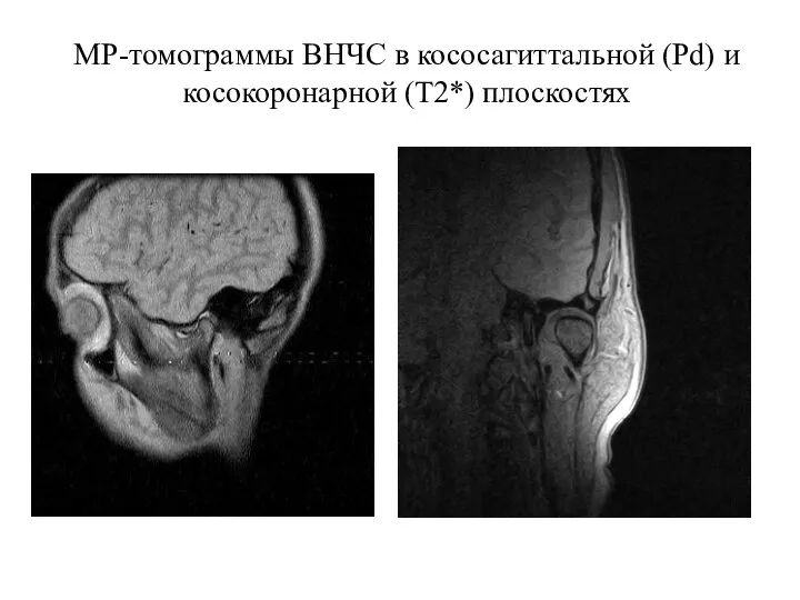 МР-томограммы ВНЧС в кососагиттальной (Pd) и косокоронарной (Т2*) плоскостях