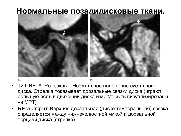 Нормальные позадидисковые ткани. Т2 GRE. А. Рот закрыт. Нормальное положение суставного диска.