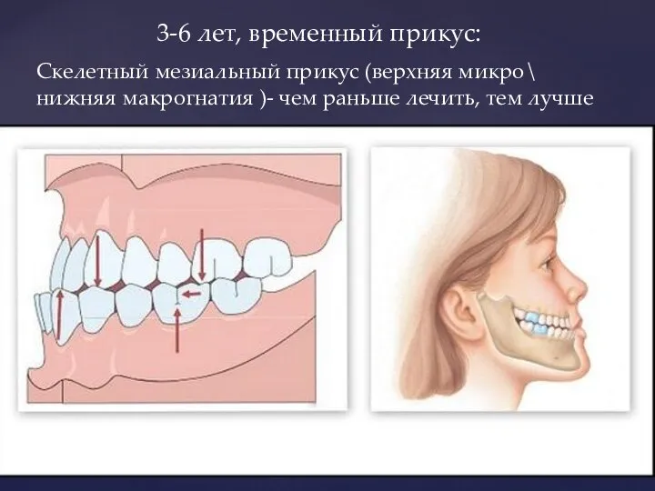 3-6 лет, временный прикус: Скелетный мезиальный прикус (верхняя микро\ нижняя макрогнатия )-