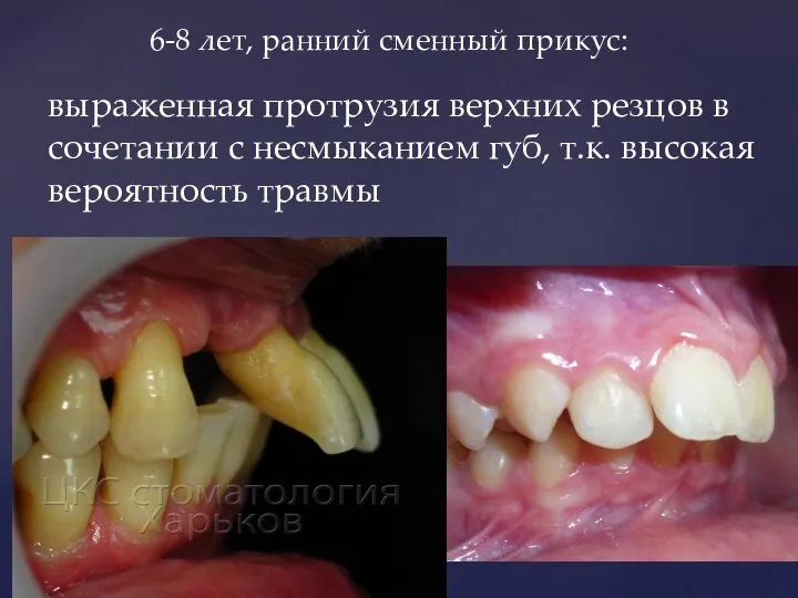 6-8 лет, ранний сменный прикус: выраженная протрузия верхних резцов в сочетании с