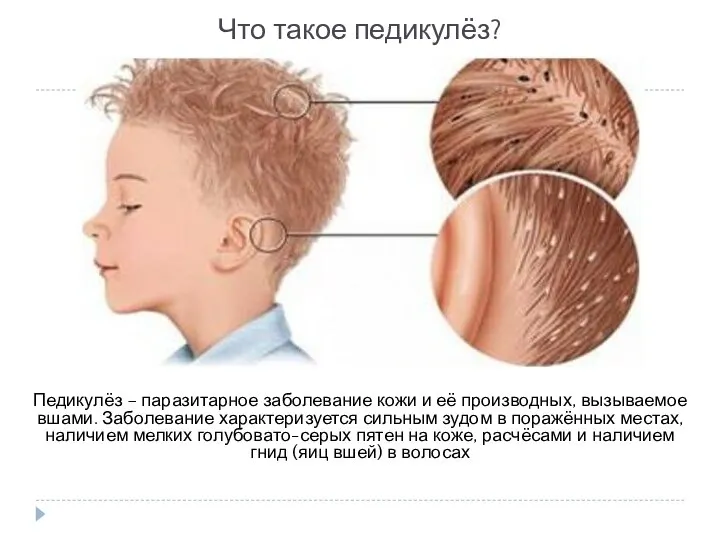 Что такое педикулёз? Педикулёз – паразитарное заболевание кожи и её производных, вызываемое