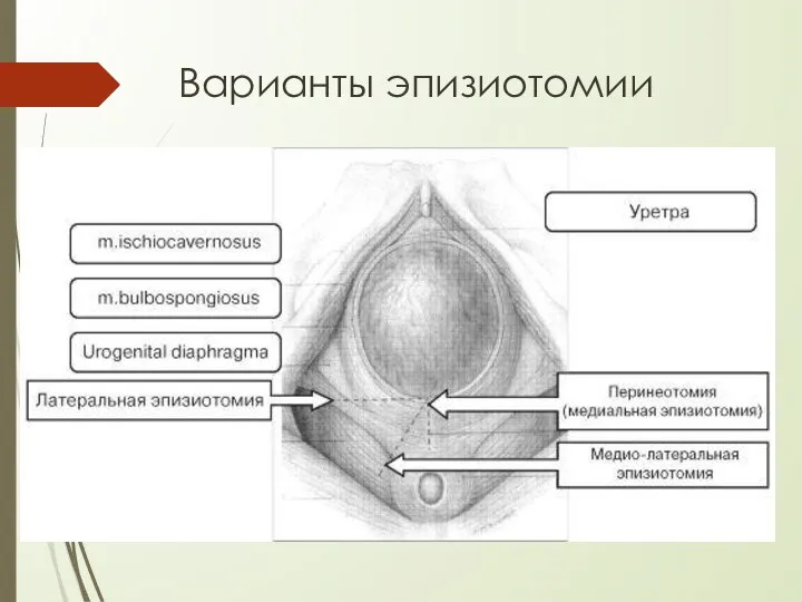 Варианты эпизиотомии