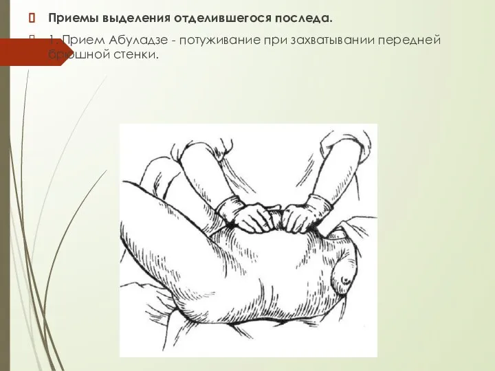 Приемы выделения отделившегося последа. 1. Прием Абуладзе - потуживание при захватывании передней брюшной стенки.