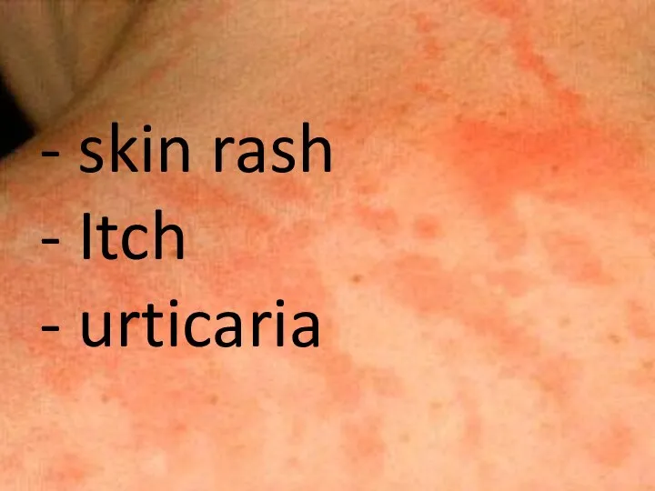 - skin rash - Itch - urticaria