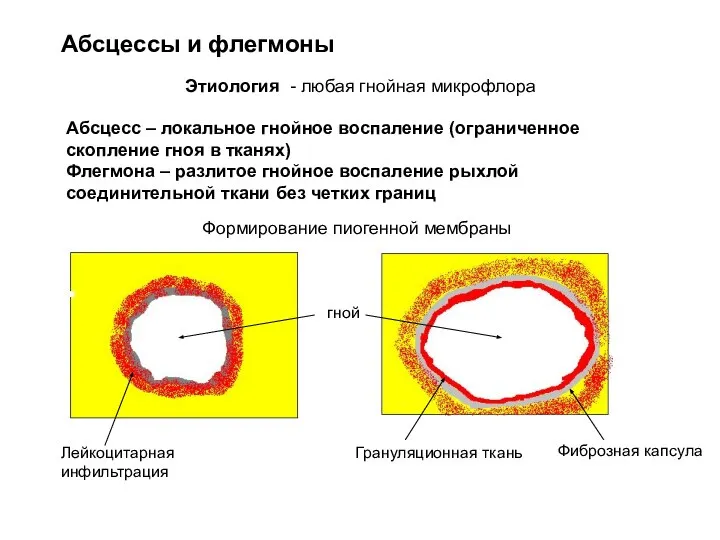 Абсцессы и флегмоны Абсцесс – локальное гнойное воспаление (ограниченное скопление гноя в