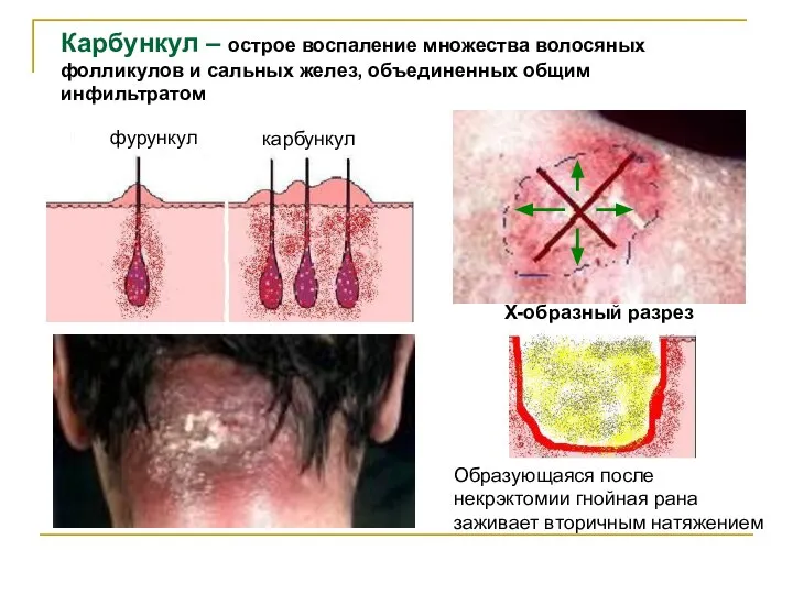 Карбункул – острое воспаление множества волосяных фолликулов и сальных желез, объединенных общим