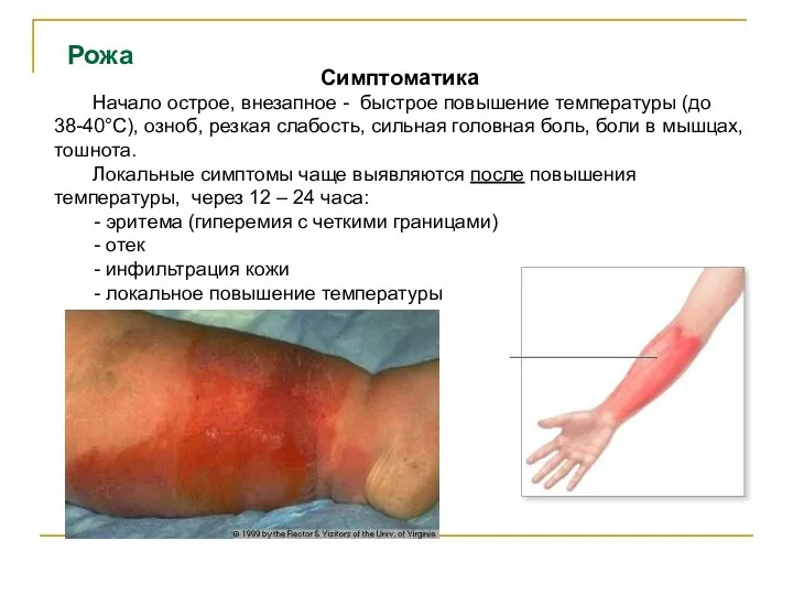 Рожа Симптоматика Начало острое, внезапное - быстрое повышение температуры (до 38-40°C), озноб,