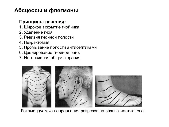 Абсцессы и флегмоны Принципы лечения: 1. Широкое вскрытие гнойника 2. Удаление гноя