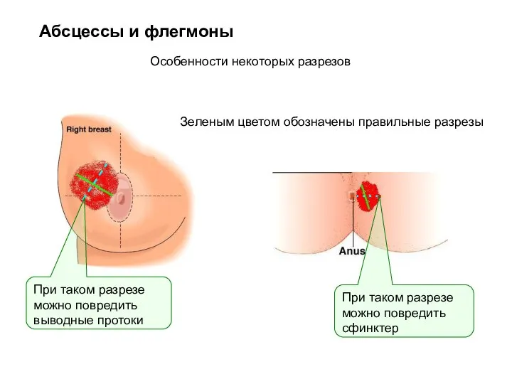 Абсцессы и флегмоны Зеленым цветом обозначены правильные разрезы Особенности некоторых разрезов При