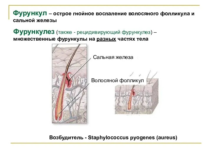 Фурункул – острое гнойное воспаление волосяного фолликула и сальной железы Фурункулез (также