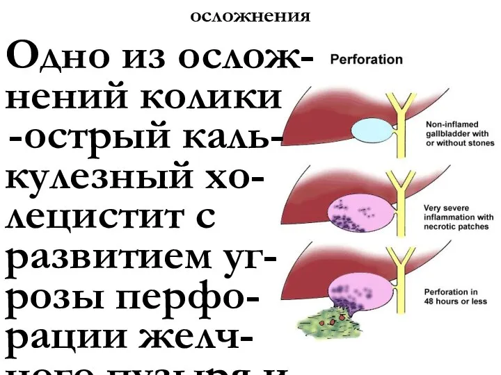 осложнения Одно из ослож- нений колики острый каль- кулезный хо- лецистит с