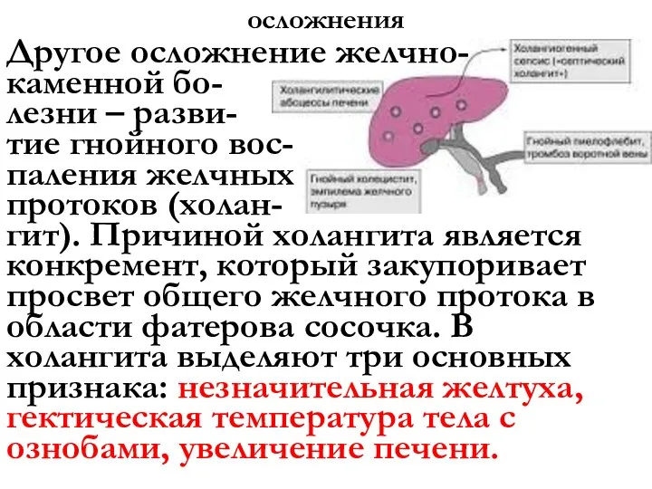 осложнения Другое осложнение желчно- каменной бо- лезни – разви- тие гнойного вос-