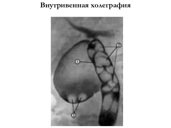 Внутривенная холеграфия