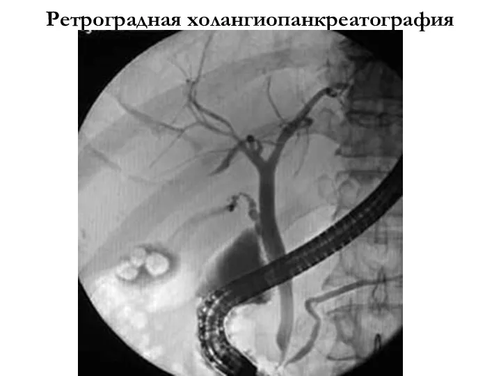 Ретроградная холангиопанкреатография