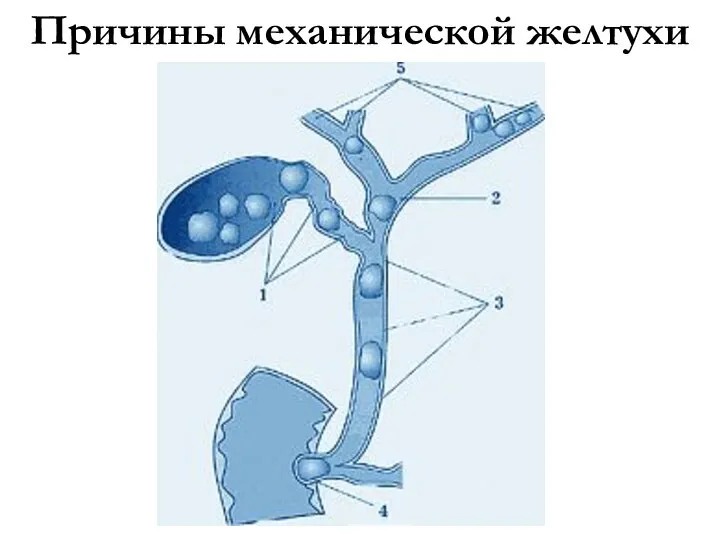 Причины механической желтухи