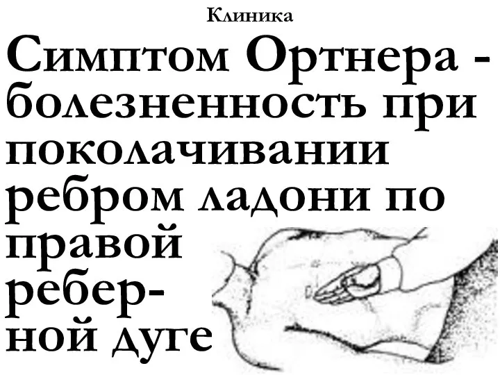 Клиника Симптом Ортнера - болезненность при поколачивании ребром ладони по правой ребер- ной дуге