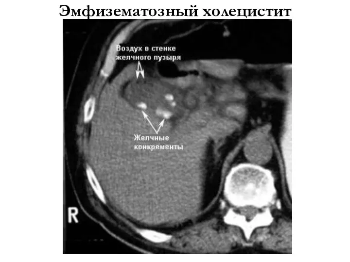 Эмфизематозный холецистит