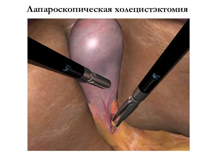 Лапароскопическая холецистэктомия