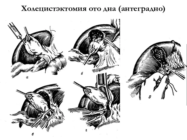 Холецистэктомия ото дна (антеградно)