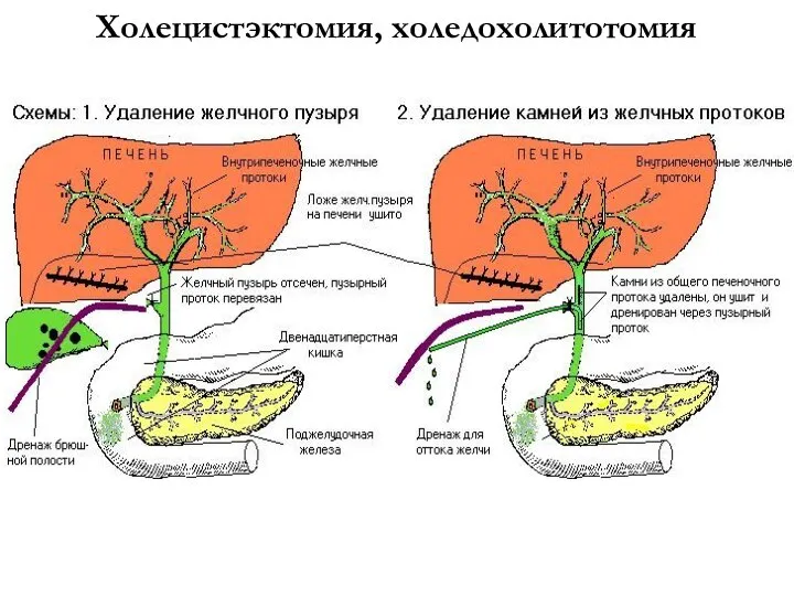 Холецистэктомия, холедохолитотомия